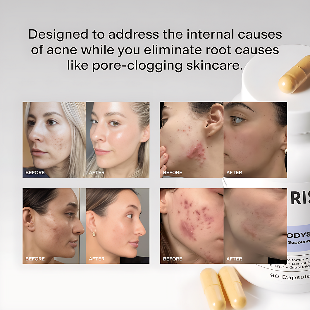 DELAIH MINDBODYSKIN ACNE SUPPLEMENT