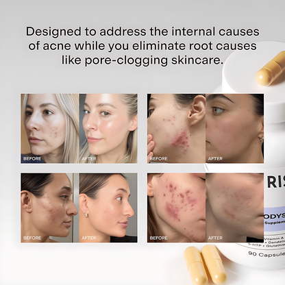 DELAIH MINDBODYSKIN ACNE SUPPLEMENT