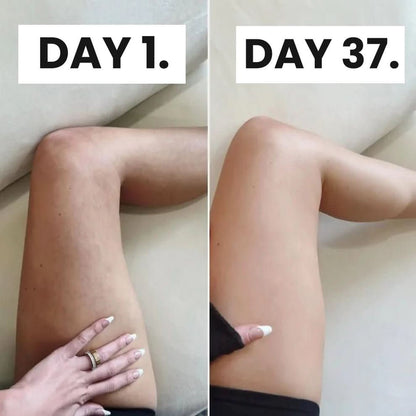 Ellevate TM Cellulite